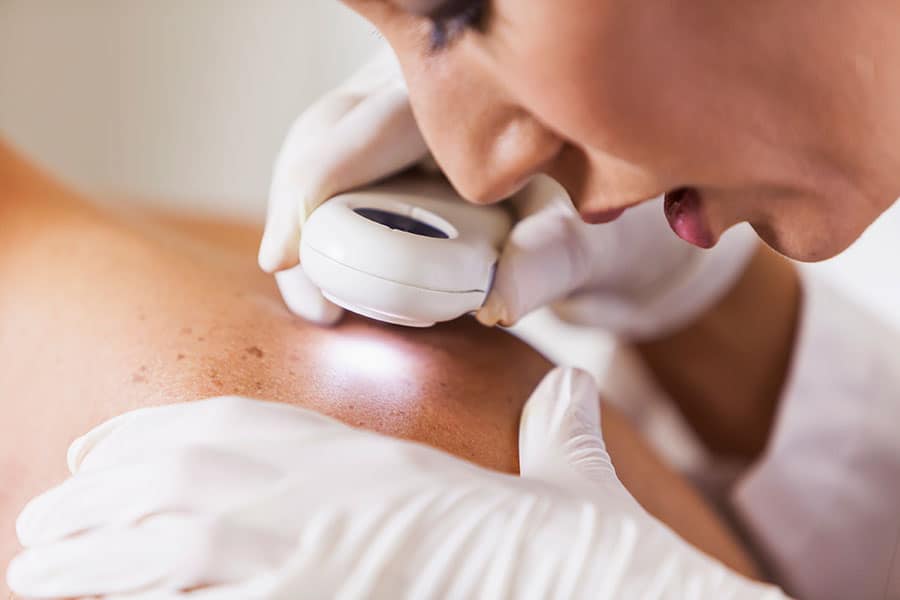 Nurse Role in Skin Cancer Prevention