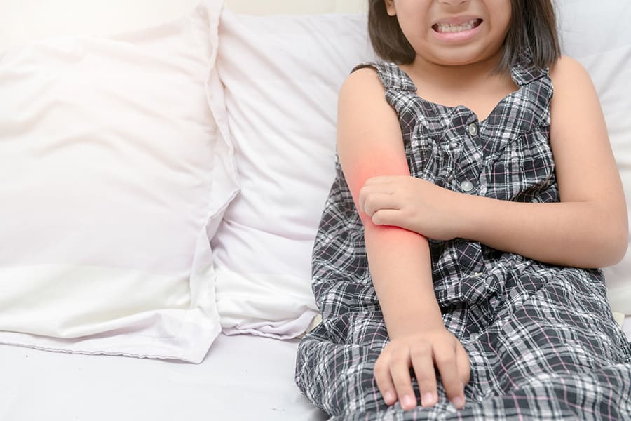 Eczema Babies