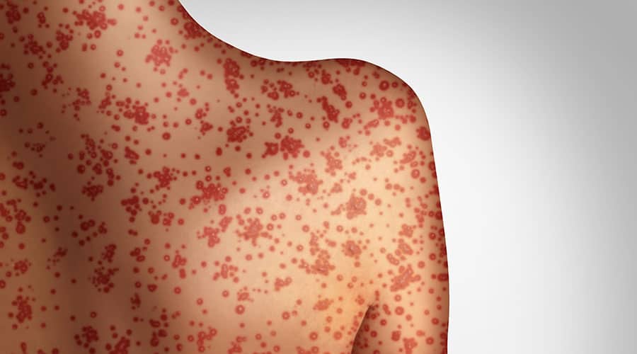 Measles Outbreaks Continue