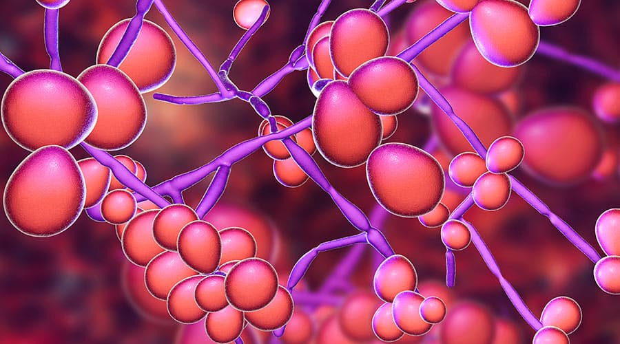 Infectious Diseases A to Z: Candidiasis (Moniliasis; Thrush)