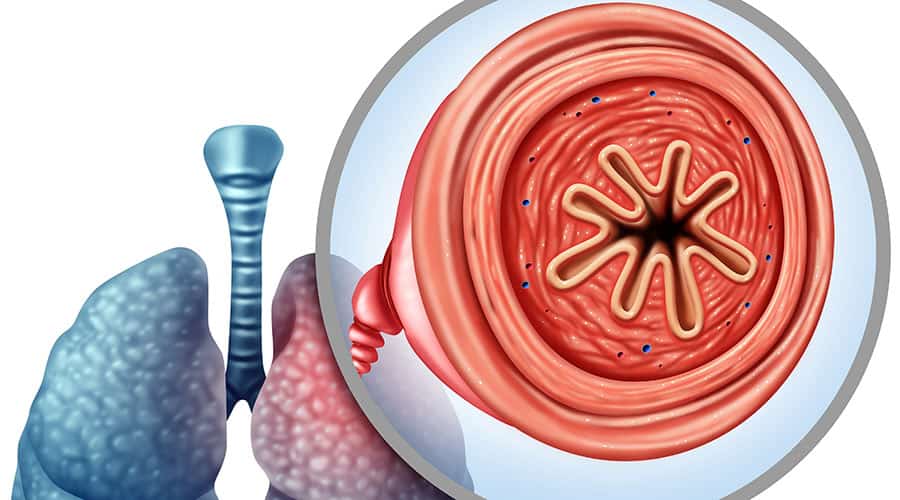 New Lung Valve Treatment for COPD Available in California