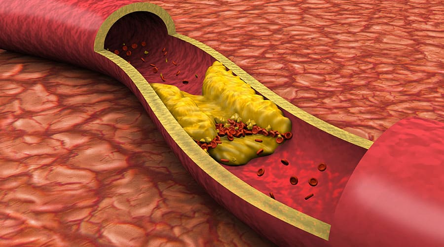 Deep Vein Thrombosis