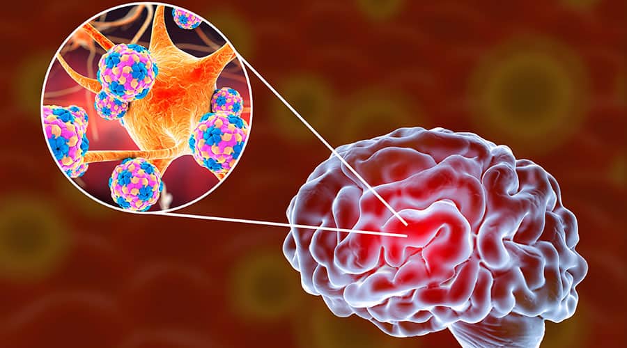Infectious Diseases A to Z: Encephalitis