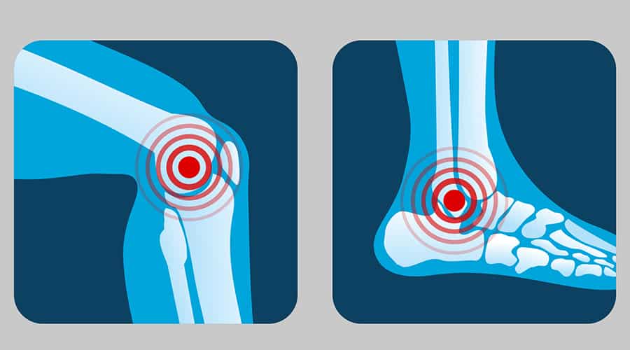 CDC Survey Highlights Arthritis Population by Age, State