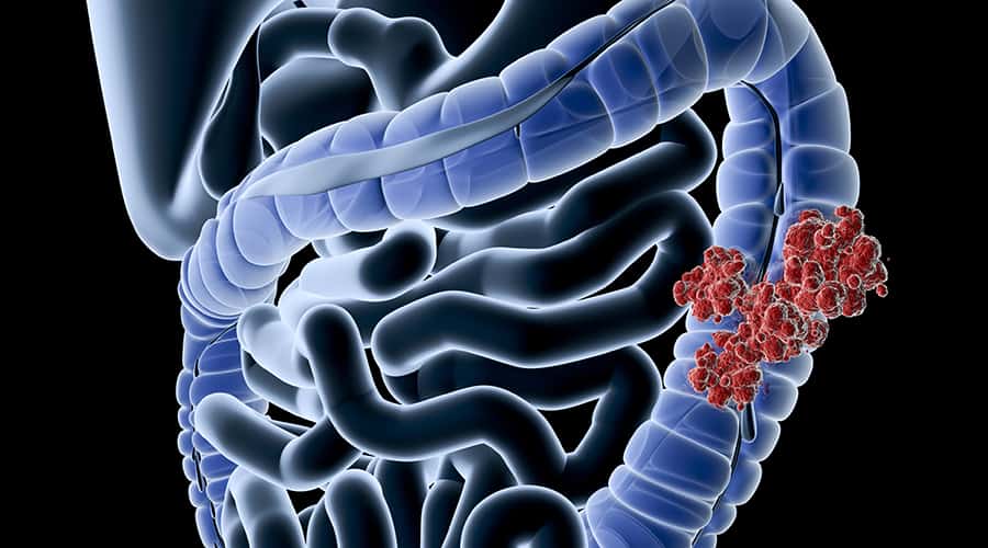 The Importance of Colorectal Cancer Screening
