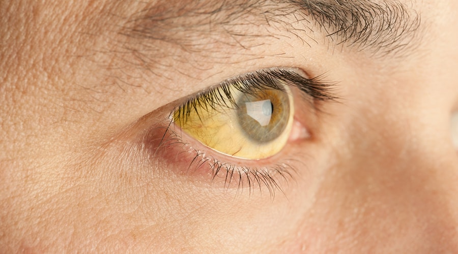 Infectious Diseases A to Z – Jaundice