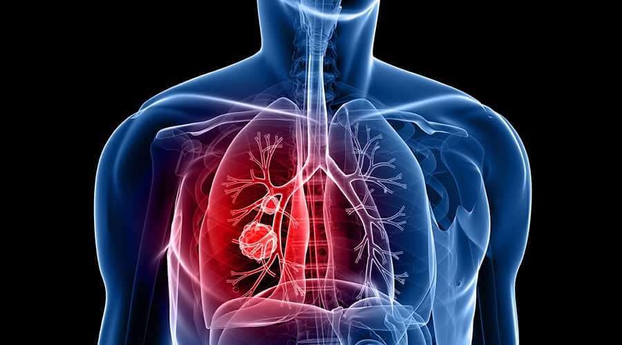 Canadian Doctor Leads Study That Could Change Lung Cancer Surgery