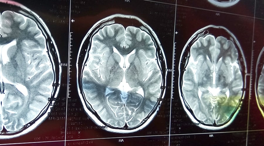Study: Medicare-covered Stroke Patients are Receiving Inconsistent Levels of Therapy