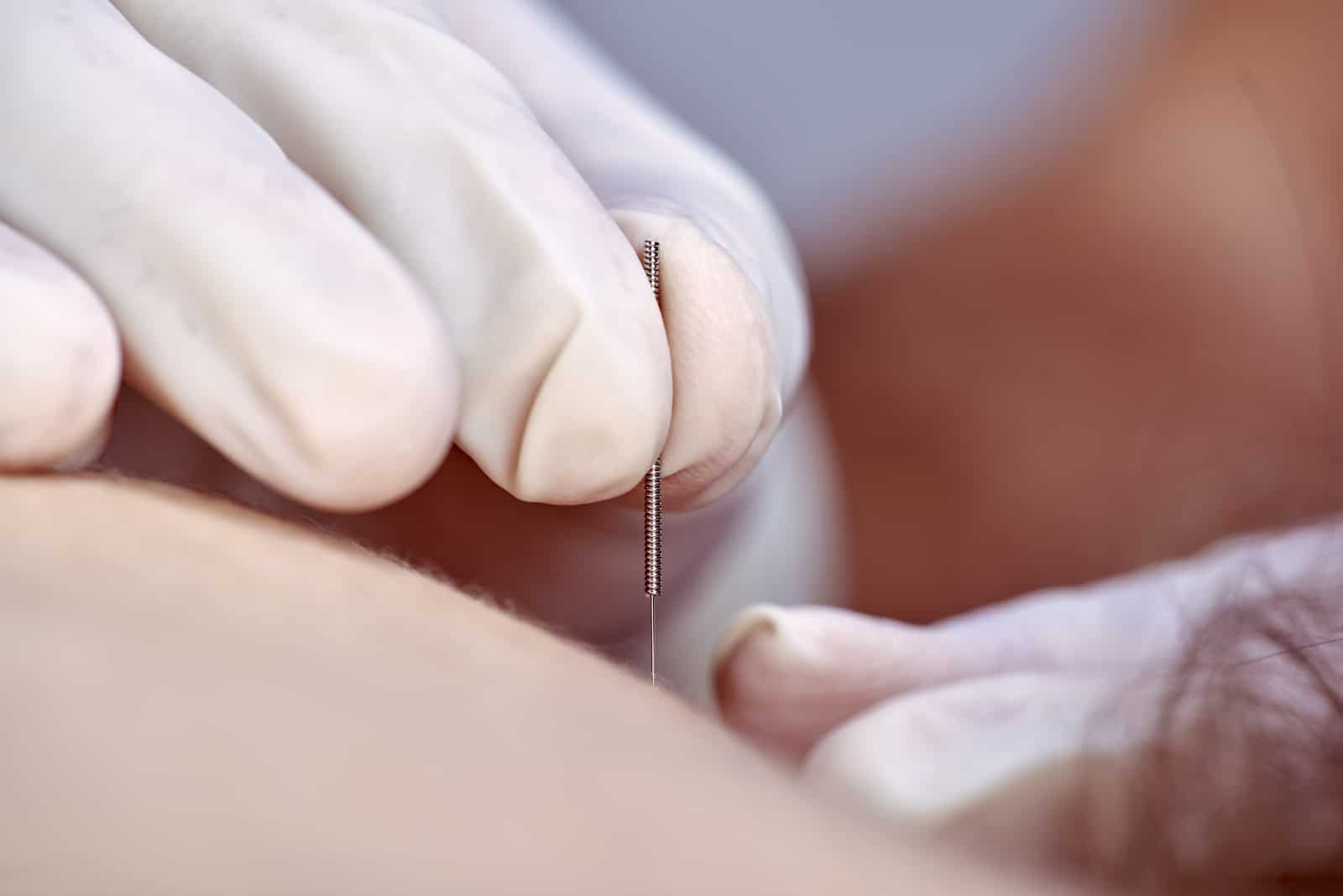 Fundamentals of Neuromuscular Dry Needling: Level-1 – Live Course