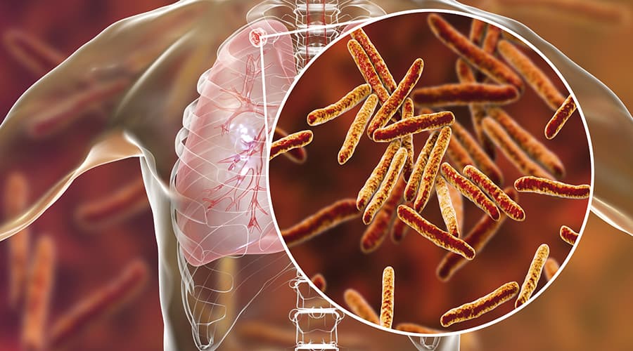 Infectious Diseases A to Z: Extensively Drug-Resistant Tuberculosis
