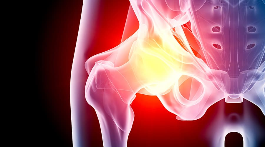 Pelvic Congestion Syndrome