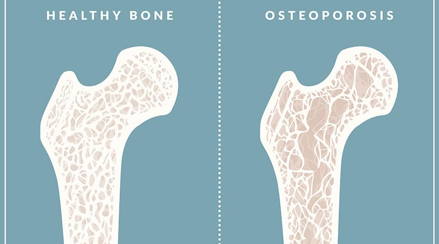 Osteopenia and Osteoporosis: Should Women Worry?