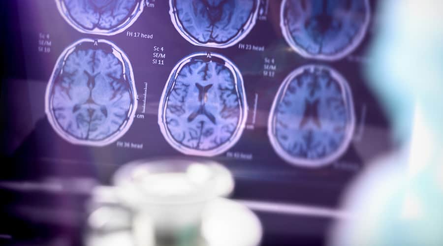 Flu, Pneumonia Vaccines May Lower Risk of Alzheimer’s