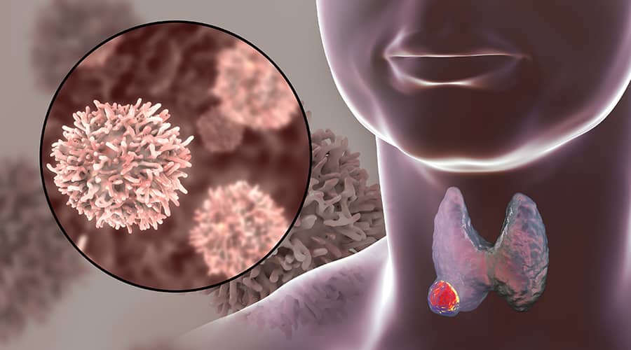 Benign or Malignant? Screening for Thyroid Cancer