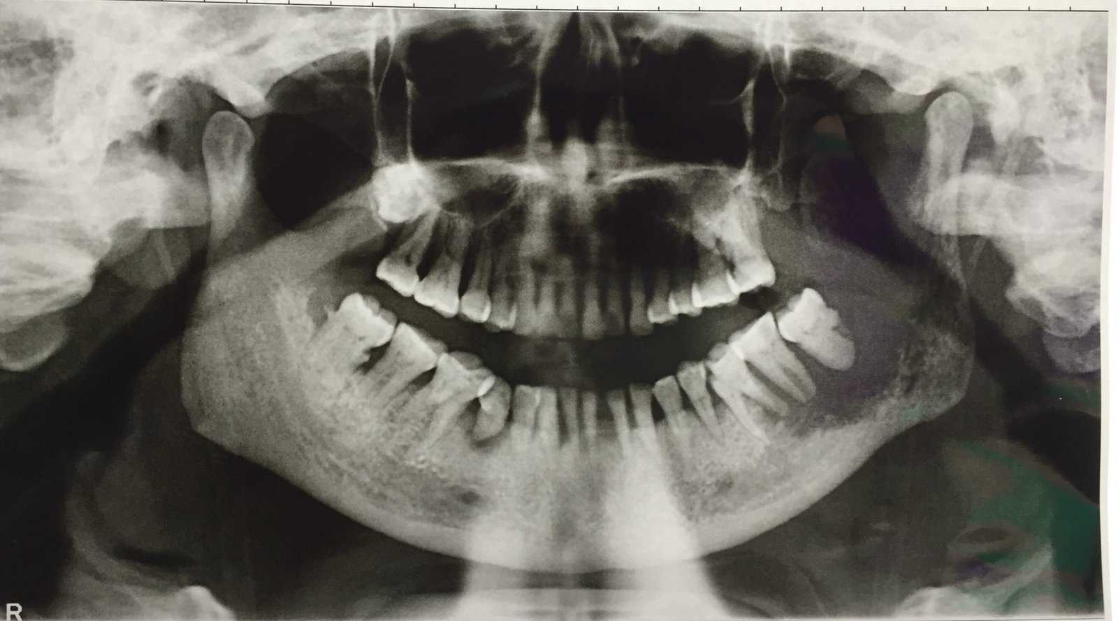 Oral Cancer: Types and Treatment Options