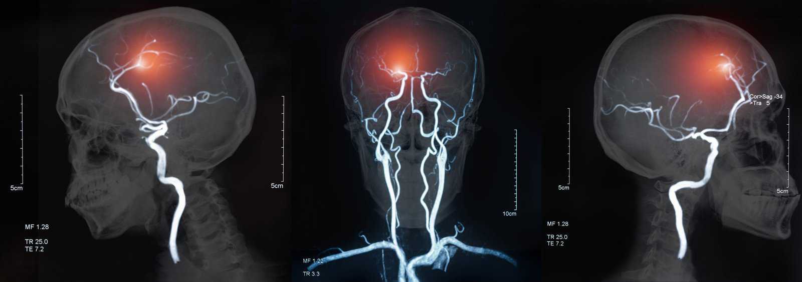 Stroke Symptoms for Occupational Therapists