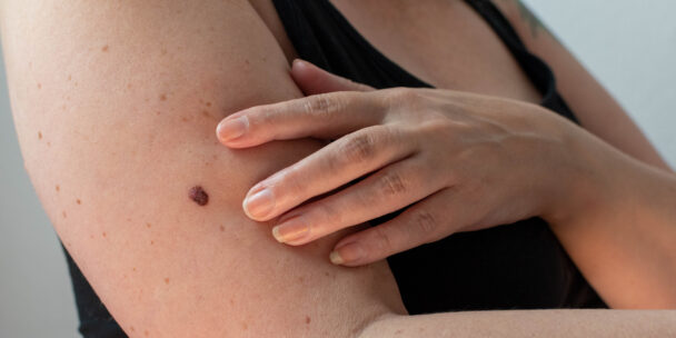 Can Estheticians Work on Clients with Skin Cancer?