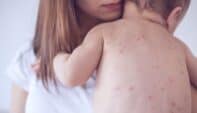 MMR Vaccine: A Review of Measles, Mumps, and Rubella for Pharmacists